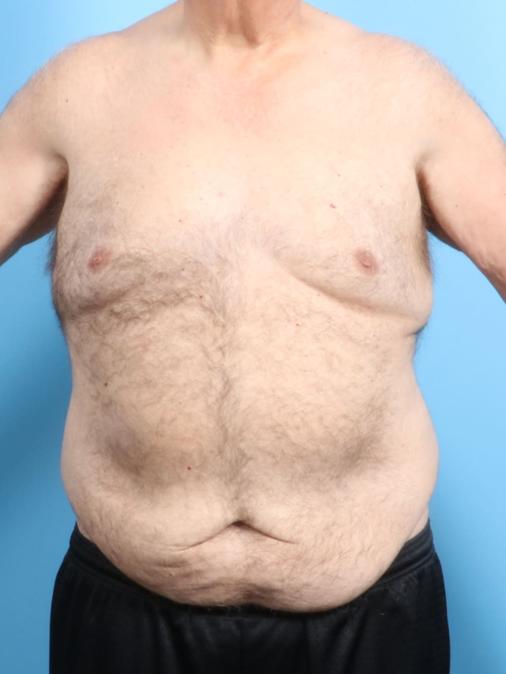 Body Lift Patient Photo Gallery | Case 2550 | Dr. Drew Davis