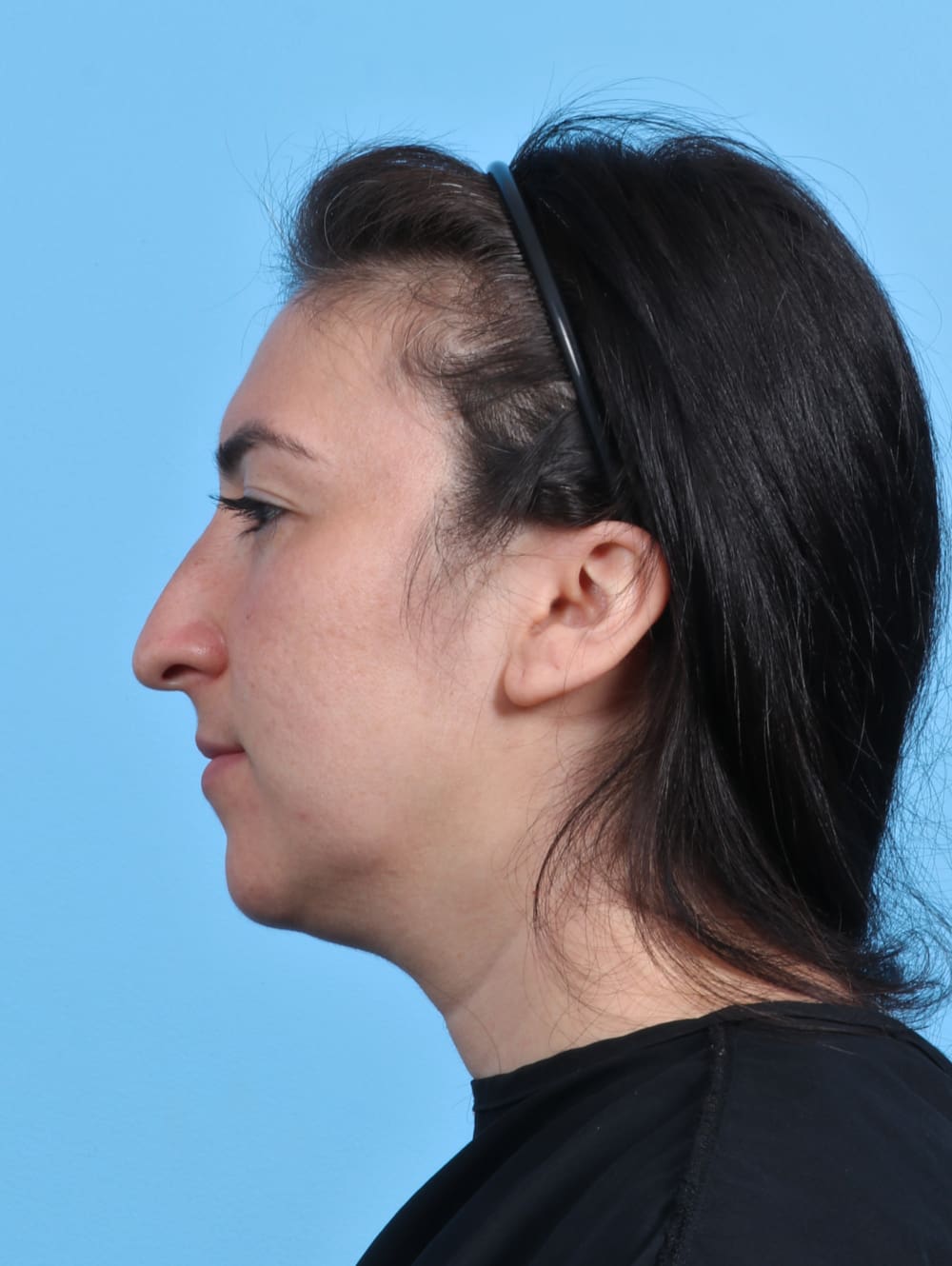 Rhinoplasty Patient Photo - Case 4155 - before view-
