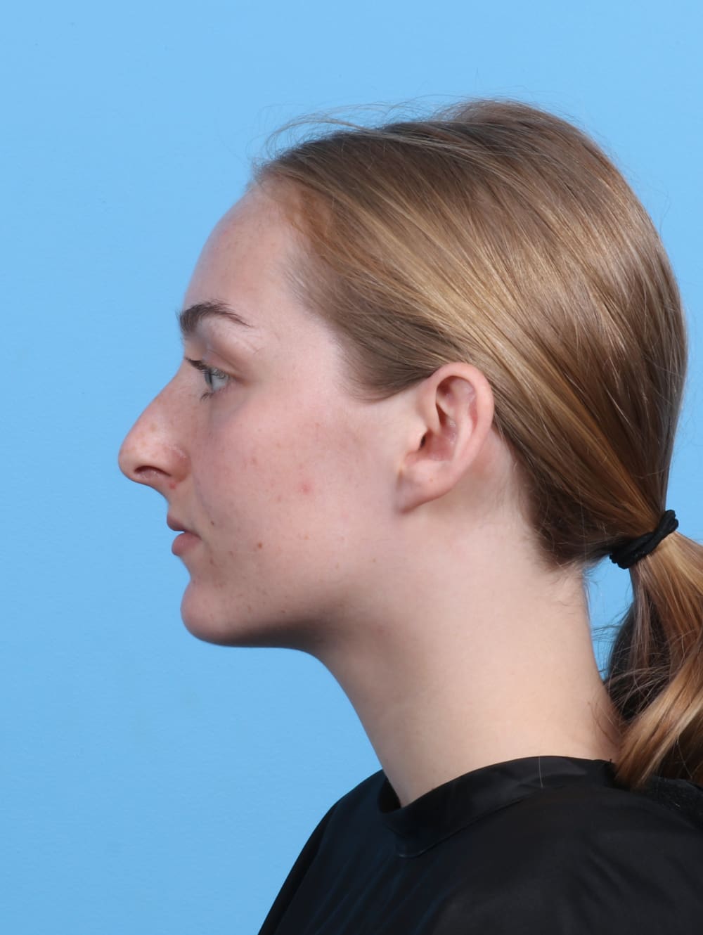 Rhinoplasty Patient Photo - Case 5103 - before view-